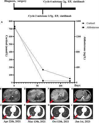 Case report: Remarkable response to a novel combination of mitotane, etoposide, paraplatin, and sintilimab in a patient with metastatic adrenocortical carcinoma